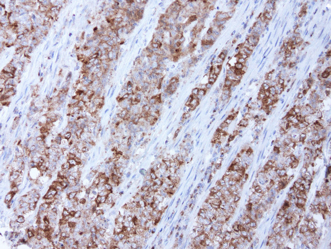 BUB1B / BubR1 Antibody - Immunohistochemical staining of paraffin-embedded human endometrial carcinoma using anti-BUB1B a mouse monoclonal antibody. Heat-induced epitope retrieval by ACCEL. (pH8.7) in pressure chamber/cooker at 110C for 3 min,clone UMAB7 at 1:250. Images shows tumor cells with strong cytoplasmic staining.