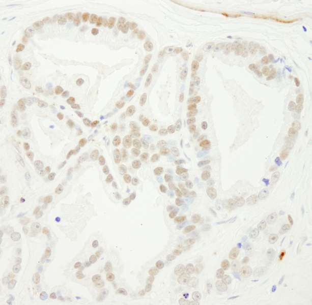 BUB3 Antibody - Detection of Human BUB3 by Immunohistochemistry. Sample: FFPE section of human prostate carcinoma. Antibody: Affinity purified rabbit anti-BUB3 used at a dilution of 1:1000 (1 ug/ml).