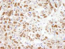 BUB3 Antibody - Detection of Human BUB3 by Immunohistochemistry. Sample: FFPE section of human metastatic lymph node. Antibody: Affinity purified rabbit anti-BUB3 used at a dilution of 1:250.
