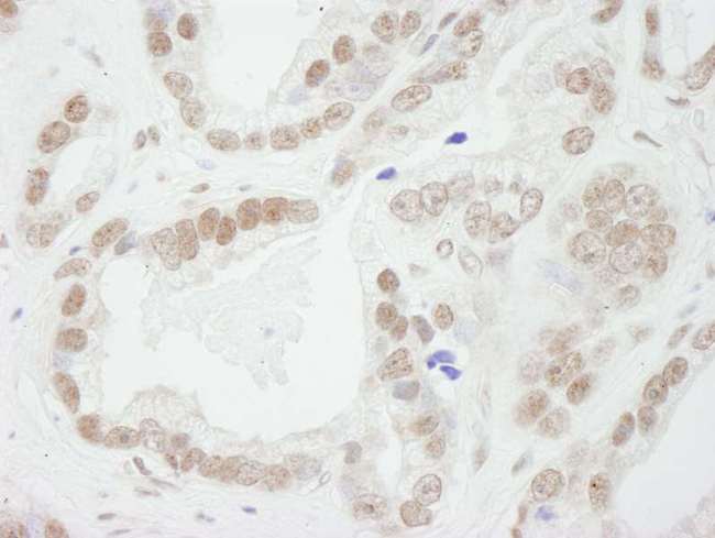 BUB3 Antibody - Detection of Human BUB3 by Immunohistochemistry. Sample: FFPE section of human prostate adenocarcinoma. Antibody: Affinity purified rabbit anti-BUB3 used at a dilution of 1:250.