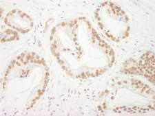 BUB3 Antibody - Detection of Human BUB3 by Immunohistochemistry. Sample: FFPE section of human prostate carcinoma. Antibody: Affinity purified rabbit anti-BUB3 used at a dilution of 1:1000 (1 ug/ml).