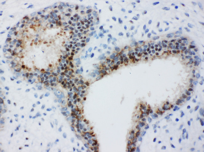 BUB3 Antibody - BUB3 antibody. IHC(P): Human Breast Cancer Tissue.