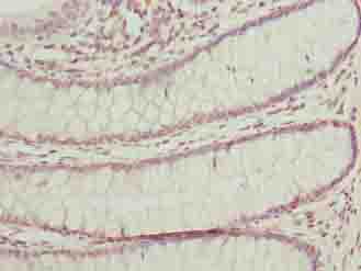 BUD31 Antibody - Immunohistochemistry of paraffin-embedded human colon cancer using antibody at dilution of 1:100.
