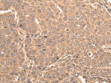BUD31 Antibody - Immunohistochemistry of paraffin-embedded Human liver cancer tissue  using BUD31 Polyclonal Antibody at dilution of 1:75(×200)