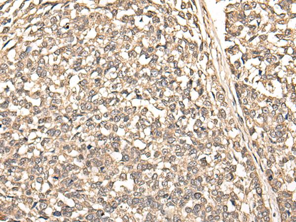 BUD31 Antibody - Immunohistochemistry of paraffin-embedded Human esophagus cancer tissue  using BUD31 Polyclonal Antibody at dilution of 1:75(×200)