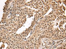 BUD31 Antibody - Immunohistochemistry of paraffin-embedded Human ovarian cancer tissue  using BUD31 Polyclonal Antibody at dilution of 1:45(×200)
