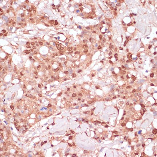 BYSL Antibody - Immunohistochemistry of paraffin-embedded Human breast cancer using BYSL Polyclonal Antibody at dilution of 1:100 (40x lens).
