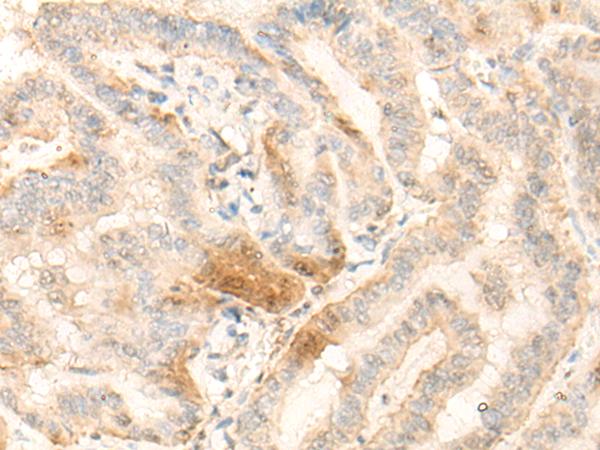 BZW2 Antibody - Immunohistochemistry of paraffin-embedded Human thyroid cancer tissue  using BZW2 Polyclonal Antibody at dilution of 1:25(×200)