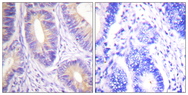 c-CBL Antibody - Immunohistochemistry analysis of paraffin-embedded human colon carcinoma tissue, using CBL Antibody. The picture on the right is blocked with the synthesized peptide.