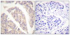 c-CBL Antibody - Immunohistochemistry analysis of paraffin-embedded human breast carcinoma tissue, using CBL Antibody. The picture on the right is blocked with the synthesized peptide.