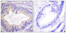 c-CBL Antibody - Immunohistochemistry analysis of paraffin-embedded human colon carcinoma tissue, using CBL Antibody. The picture on the right is blocked with the synthesized peptide.