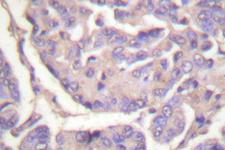 c-CBL Antibody - IHC of CBL (G694) pAb in paraffin-embedded human breast carcinoma tissue.