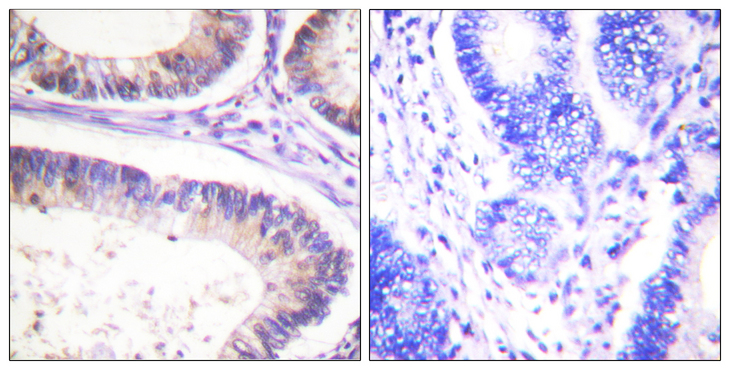 c-CBL Antibody - Immunohistochemistry analysis of paraffin-embedded human colon carcinoma, using CBL (Phospho-Tyr674) Antibody. The picture on the right is blocked with the phospho peptide.