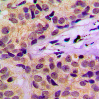 c-CBL Antibody - Immunohistochemical analysis of c-CBL (pY674) staining in human cervical cancer formalin fixed paraffin embedded tissue section. The section was pre-treated using heat mediated antigen retrieval with sodium citrate buffer (pH 6.0). The section was then incubated with the antibody at room temperature and detected using an HRP conjugated compact polymer system. DAB was used as the chromogen. The section was then counterstained with hematoxylin and mounted with DPX.