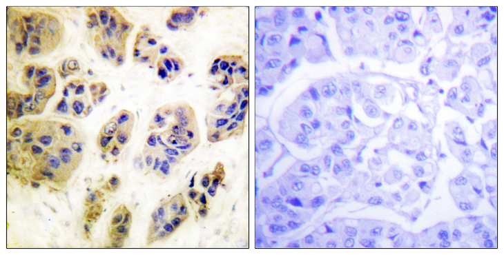 c-CBL Antibody - Immunohistochemistry analysis of paraffin-embedded human breast carcinoma, using CBL (Phospho-Tyr700) Antibody. The picture on the right is blocked with the phospho peptide.