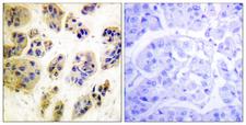 c-CBL Antibody - Immunohistochemistry analysis of paraffin-embedded human breast carcinoma, using CBL (Phospho-Tyr700) Antibody. The picture on the right is blocked with the phospho peptide.