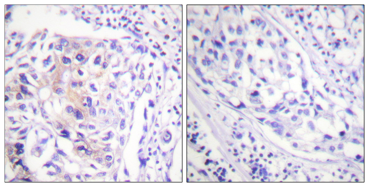 c-CBL Antibody - Immunohistochemistry analysis of paraffin-embedded human breast carcinoma, using CBL (Phospho-Tyr774) Antibody. The picture on the right is blocked with the phospho peptide.