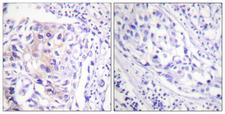 c-CBL Antibody - Immunohistochemistry analysis of paraffin-embedded human breast carcinoma, using CBL (Phospho-Tyr774) Antibody. The picture on the right is blocked with the phospho peptide.