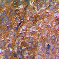 c-CBL Antibody - Immunohistochemical analysis of c-CBL (pY774) staining in human breast cancer formalin fixed paraffin embedded tissue section. The section was pre-treated using heat mediated antigen retrieval with sodium citrate buffer (pH 6.0). The section was then incubated with the antibody at room temperature and detected using an HRP conjugated compact polymer system. DAB was used as the chromogen. The section was then counterstained with hematoxylin and mounted with DPX.