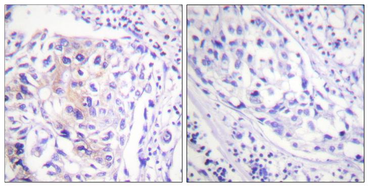 c-CBL Antibody - P-peptide - + Immunohistochemistry analysis of paraffin-embedded human breast carcinoma tissue using CBL (Phospho-Tyr774) antibody.