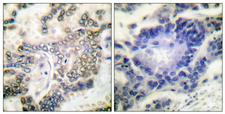 C/EBP Alpha / CEBPA Antibody - Immunohistochemistry analysis of paraffin-embedded human lung carcinoma tissue, using C/EBP-alpha Antibody. The picture on the right is blocked with the synthesized peptide.