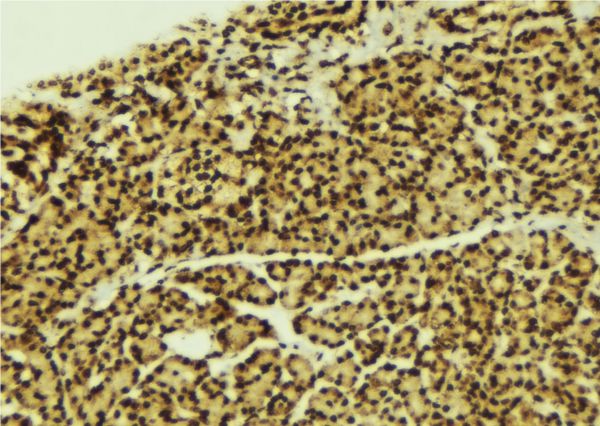 C/EBP Alpha / CEBPA Antibody - 1:100 staining human breast carcinoma tissue by IHC-P. The sample was formaldehyde fixed and a heat mediated antigen retrieval step in citrate buffer was performed. The sample was then blocked and incubated with the antibody for 1.5 hours at 22°C. An HRP conjugated goat anti-rabbit antibody was used as the secondary.