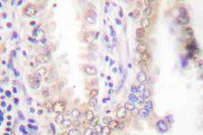 C/EBP Alpha / CEBPA Antibody - Immunohistochemistry (IHC) analysis of p-C/EBP alpha (S21) pAb in paraffin-embedded human lung cancer tissue.