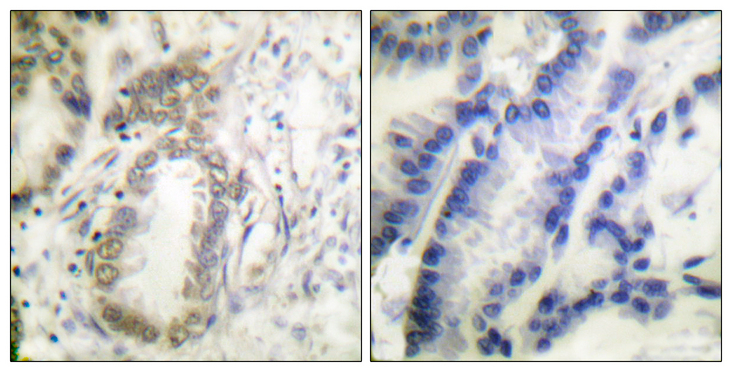 C/EBP Alpha / CEBPA Antibody - Immunohistochemistry analysis of paraffin-embedded human lung carcinoma, using C/EBP-alpha (Phospho-Ser21) Antibody. The picture on the right is blocked with the phospho peptide.