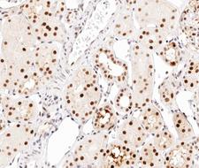 C/EBP Alpha / CEBPA Antibody - 1:200 staining human kidney carcinoma tissue by IHC-P. The tissue was formaldehyde fixed and a heat mediated antigen retrieval step in citrate buffer was performed. The tissue was then blocked and incubated with the antibody for 1.5 hours at 22° C. An HRP conjugated goat anti-rabbit antibody was used as the secondary.