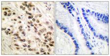 C/EBP Beta / CEBPB Antibody - Immunohistochemistry analysis of paraffin-embedded human lung carcinoma tissue, using C/EBP-beta Antibody. The picture on the right is blocked with the synthesized peptide.