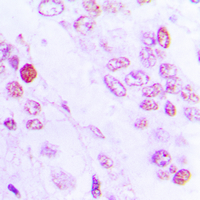 C/EBP Beta / CEBPB Antibody - Immunohistochemical analysis of C/EBP beta staining in human lung cancer formalin fixed paraffin embedded tissue section. The section was pre-treated using heat mediated antigen retrieval with sodium citrate buffer (pH 6.0). The section was then incubated with the antibody at room temperature and detected using an HRP conjugated compact polymer system. DAB was used as the chromogen. The section was then counterstained with hematoxylin and mounted with DPX.