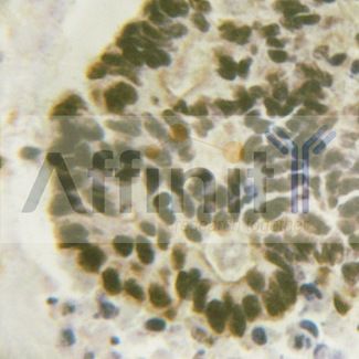 C/EBP Beta / CEBPB Antibody - 1/100 staining human breast carcinoma tissue by IHC-P. The sample was formaldehyde fixed and a heat mediated antigen retrieval step in citrate buffer was performed. The sample was then blocked and incubated with the antibody for 1.5 hours at 22°C. An HRP conjugated goat anti-rabbit antibody was used as the secondary antibody.