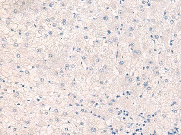 C/EBP Beta / CEBPB Antibody - Immunohistochemistry of paraffin-embedded Human liver cancer tissue  using CEBPB  Polyclonal Antibody at dilution of 1:30(×200)