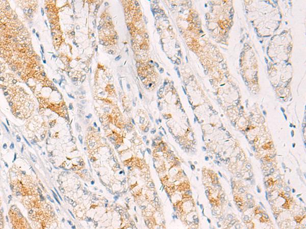 C/EBP Beta / CEBPB Antibody - Immunohistochemistry of paraffin-embedded Human gastric cancer tissue  using CEBPB  Polyclonal Antibody at dilution of 1:30(×200)