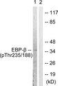 C/EBP Beta / CEBPB Antibody - P-Peptide - + Immunohistochemical analysis of paraffin-embedded human breast carcinoma tissue using C/EBP-ß (phospho-Thr235/188) antibody.