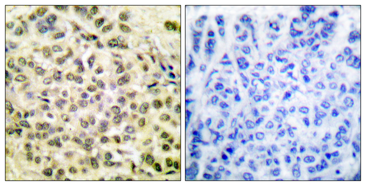 C/EBP Beta / CEBPB Antibody - Immunohistochemistry analysis of paraffin-embedded human breast carcinoma, using C/EBP-beta (Phospho-Thr235/188) Antibody. The picture on the right is blocked with the phospho peptide.
