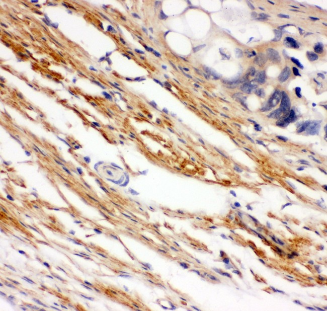 c-Kit / CD117 Antibody - C-Kit antibody IHC-paraffin: Human Intestinal Cancer Tissue.