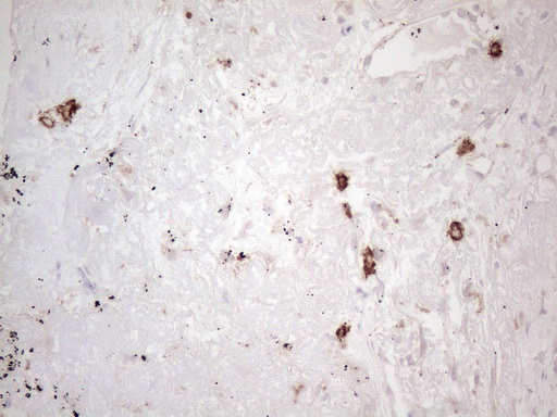 c-Kit / CD117 Antibody - Immunohistochemical staining of paraffin-embedded Carcinoma of Human lung tissue using anti-KIT mouse monoclonal antibody. (Heat-induced epitope retrieval by 1mM EDTA in 10mM Tris buffer. (pH8.5) at 120°C for 3 min. (1:150)