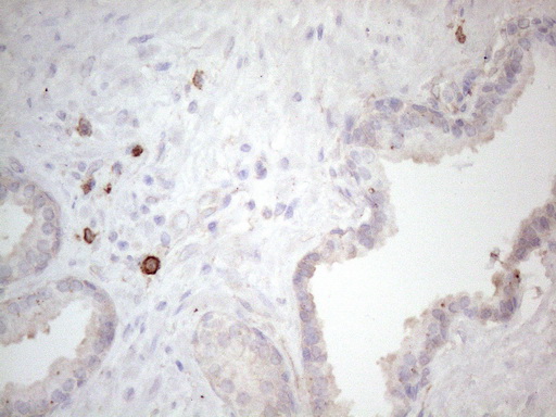 c-Kit / CD117 Antibody - Immunohistochemical staining of paraffin-embedded Carcinoma of Human prostate tissue using anti-KIT mouse monoclonal antibody. (Heat-induced epitope retrieval by 1mM EDTA in 10mM Tris buffer. (pH8.5) at 120°C for 3 min. (1:150)