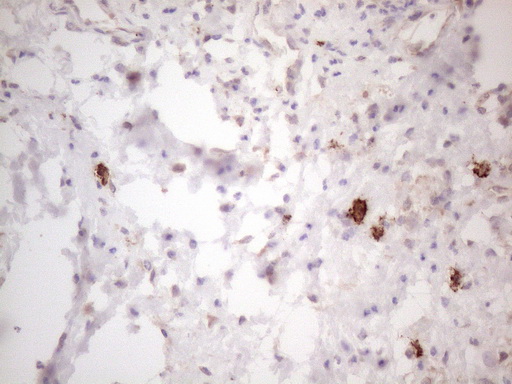 c-Kit / CD117 Antibody - Immunohistochemical staining of paraffin-embedded Carcinoma of Human bladder tissue using anti-KIT mouse monoclonal antibody. (Heat-induced epitope retrieval by 1mM EDTA in 10mM Tris buffer. (pH8.5) at 120°C for 3 min. (1:150)