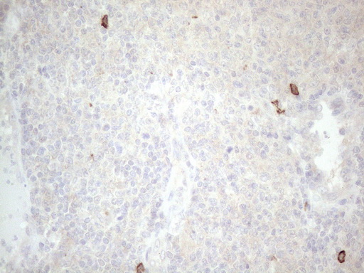 c-Kit / CD117 Antibody - Immunohistochemical staining of paraffin-embedded Human lymphoma tissue using anti-KIT mouse monoclonal antibody. (Heat-induced epitope retrieval by 1mM EDTA in 10mM Tris buffer. (pH8.5) at 120°C for 3 min. (1:150)