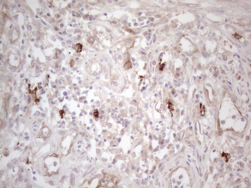 c-Kit / CD117 Antibody - Immunohistochemical staining of paraffin-embedded Adenocarcinoma of Human colon tissue using anti-KIT mouse monoclonal antibody. (Heat-induced epitope retrieval by 1mM EDTA in 10mM Tris buffer. (pH8.5) at 120°C for 3 min. (1:150)