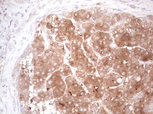 c-Kit / CD117 Antibody - Immunohistochemical staining of paraffin-embedded Carcinoma of Human liver tissue using anti-KIT mouse monoclonal antibody. (Heat-induced epitope retrieval by 1mM EDTA in 10mM Tris buffer. (pH8.5) at 120°C for 3 min. (1:150)