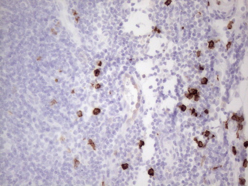 c-Kit / CD117 Antibody - Immunohistochemical staining of paraffin-embedded Carcinoma of Human thyroid tissue using anti-KIT mouse monoclonal antibody. (Heat-induced epitope retrieval by 1mM EDTA in 10mM Tris buffer. (pH8.5) at 120°C for 3 min. (1:150)