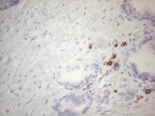 c-Kit / CD117 Antibody - Immunohistochemical staining of paraffin-embedded Carcinoma of Human prostate tissue using anti-KIT mouse monoclonal antibody. (Heat-induced epitope retrieval by 1mM EDTA in 10mM Tris buffer. (pH8.5) at 120°C for 3 min. (1:150)