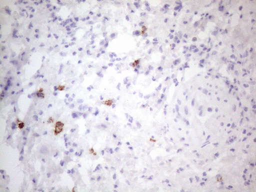 c-Kit / CD117 Antibody - Immunohistochemical staining of paraffin-embedded Carcinoma of Human bladder tissue using anti-KIT mouse monoclonal antibody. (Heat-induced epitope retrieval by 1mM EDTA in 10mM Tris buffer. (pH8.5) at 120°C for 3 min. (1:150)