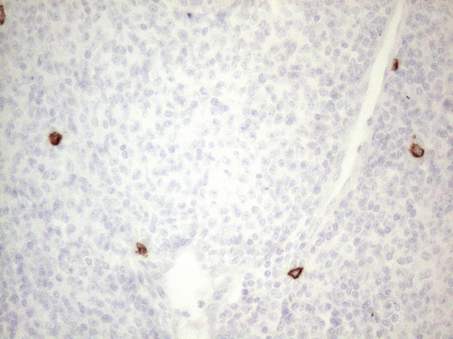 c-Kit / CD117 Antibody - Immunohistochemical staining of paraffin-embedded Human lymphoma tissue using anti-KIT mouse monoclonal antibody. (Heat-induced epitope retrieval by 1mM EDTA in 10mM Tris buffer. (pH8.5) at 120°C for 3 min. (1:150)
