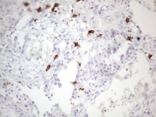 c-Kit / CD117 Antibody - Immunohistochemical staining of paraffin-embedded Adenocarcinoma of Human colon tissue using anti-KIT mouse monoclonal antibody. (Heat-induced epitope retrieval by 1mM EDTA in 10mM Tris buffer. (pH8.5) at 120°C for 3 min. (1:150)