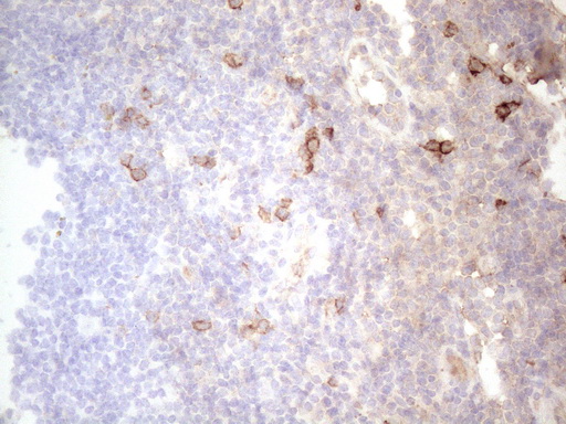 c-Kit / CD117 Antibody - Immunohistochemical staining of paraffin-embedded Carcinoma of Human thyroid tissue using anti-KIT mouse monoclonal antibody. (Heat-induced epitope retrieval by 1mM EDTA in 10mM Tris buffer. (pH8.5) at 120°C for 3 min. (1:150)