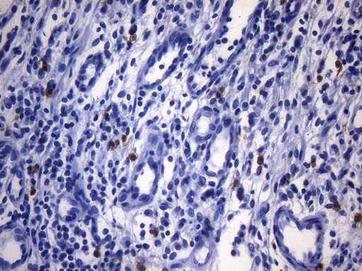 c-Kit / CD117 Antibody - Immunohistochemical staining of paraffin-embedded human gastric carcinoma using anti-KIT mouse monoclonal antibody. HIER pretreatment was done with 1mM EDTA in 10mM Tris buffer. (pH8.0) at 120°C for 2.5 minutes.was diluted 1:400 and detection was done with HRP secondary and DAB chromogen. Cytoplasmic and mebraneous positive stain seen in very few tumor cells.